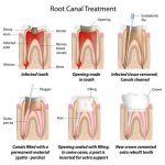 Bridges and Root Canals - Cosmetic Dentist Anaheim | Dental Implants