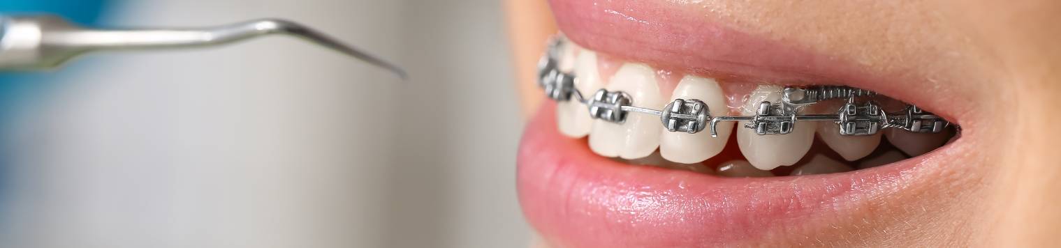 Woman with Dental Braces Visiting Dentist in Clinic, Closeup